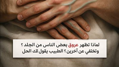 لماذا تظهر عروق بعض الناس من الجلد وتختفي عن آخرين الطبيب يقول لك الحل والسبب